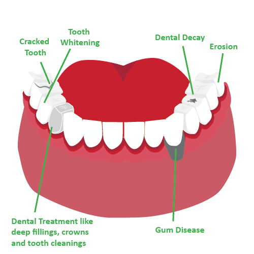 Illustration of a bottom jaw and teeth with green indicators pointing to different areas indicating causes of tooth sensitivity. Text says, "cracked tooth", "tooth whitening", "dental treatment like deep fillings, crowns and tooth cleanings", "dental decay", "gum disease" and "erosion".