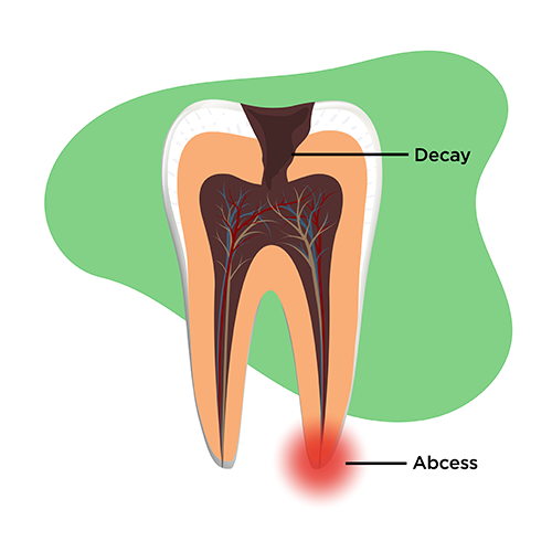 Illustration of a tooth with decay present and an abscess near the root