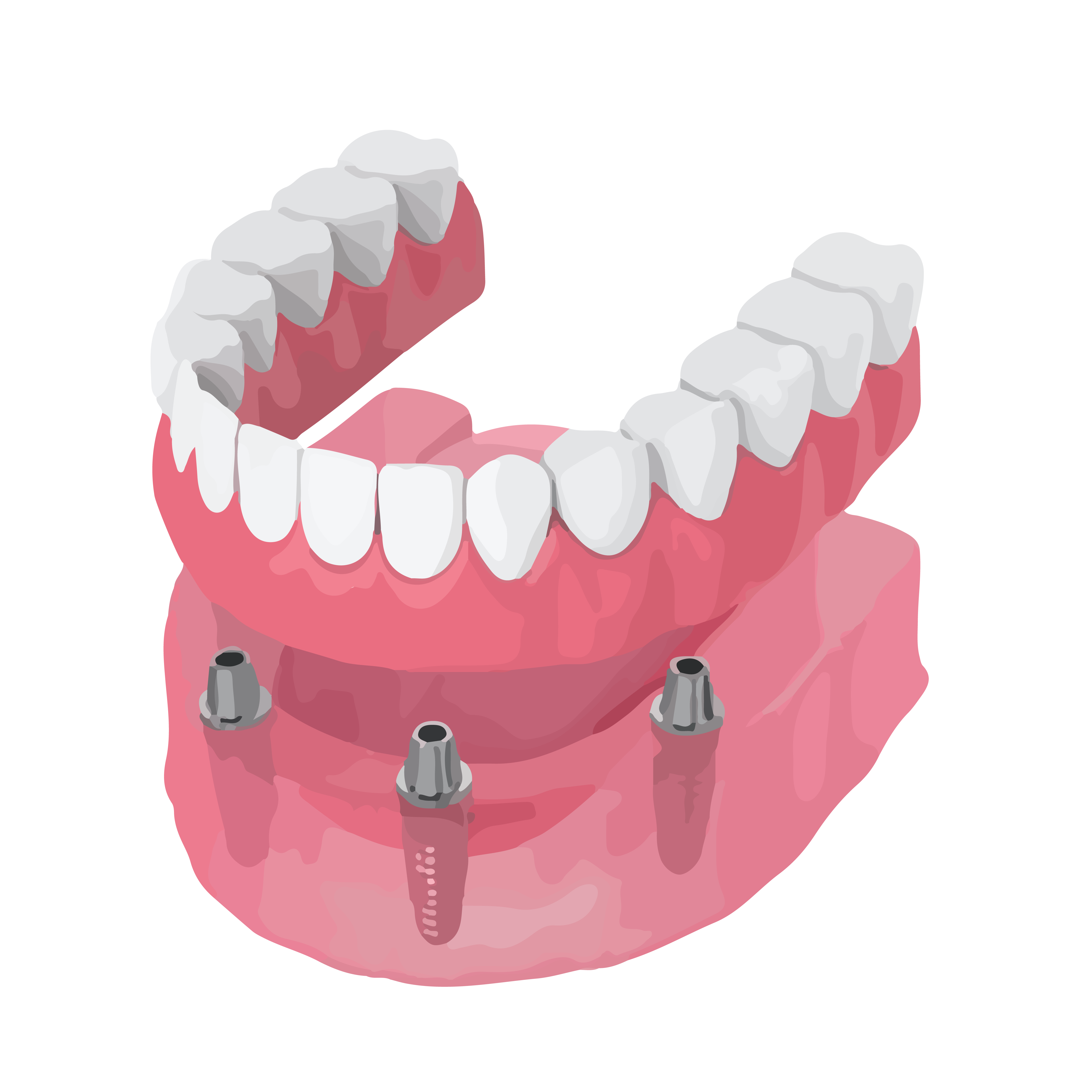 Dental implants installed to hold bottom denture in place