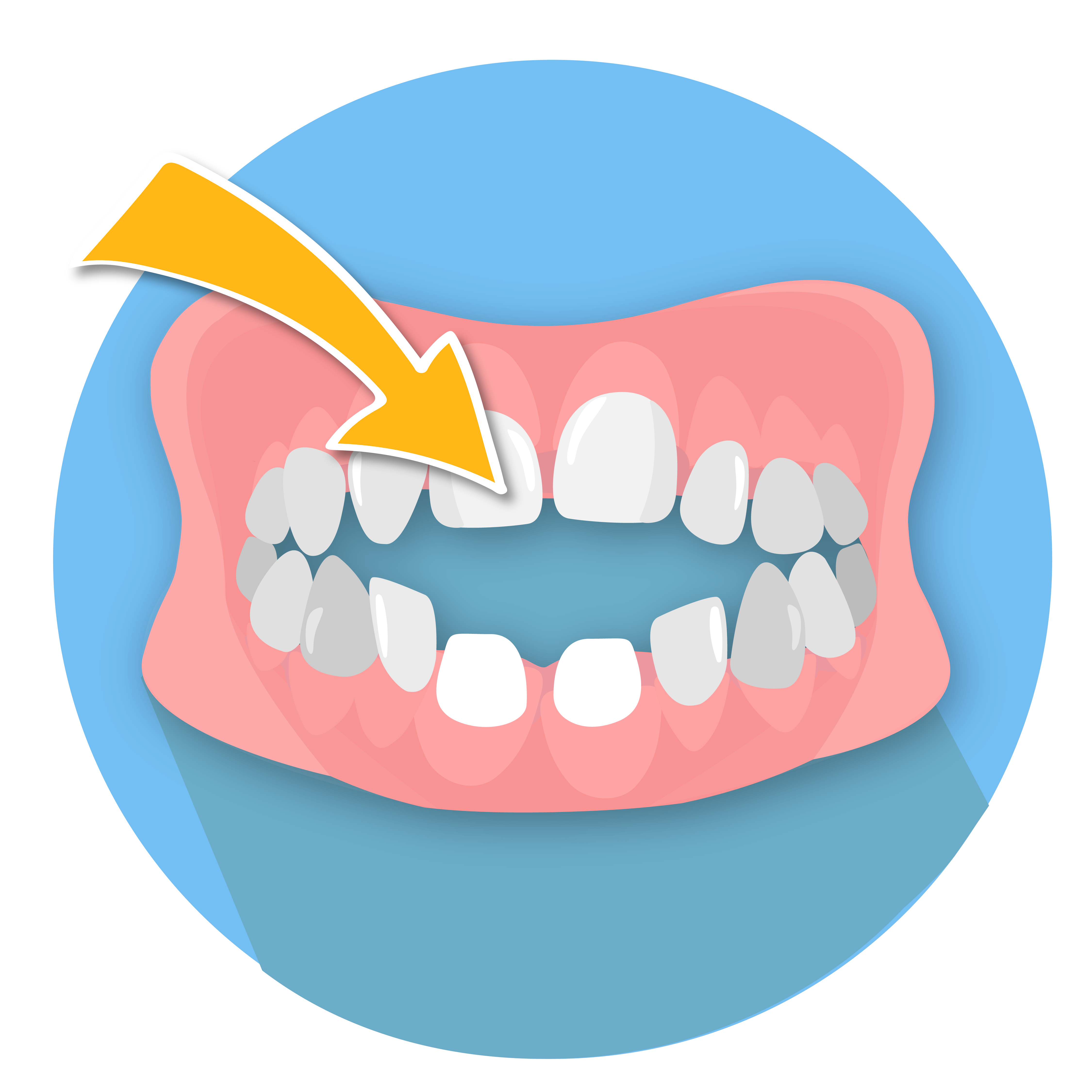 Illustration of an open bite - meaning the front teeth in a childs mouth do not meet. the top teeth protrude out and forward slightly due to sucking their thumb. 