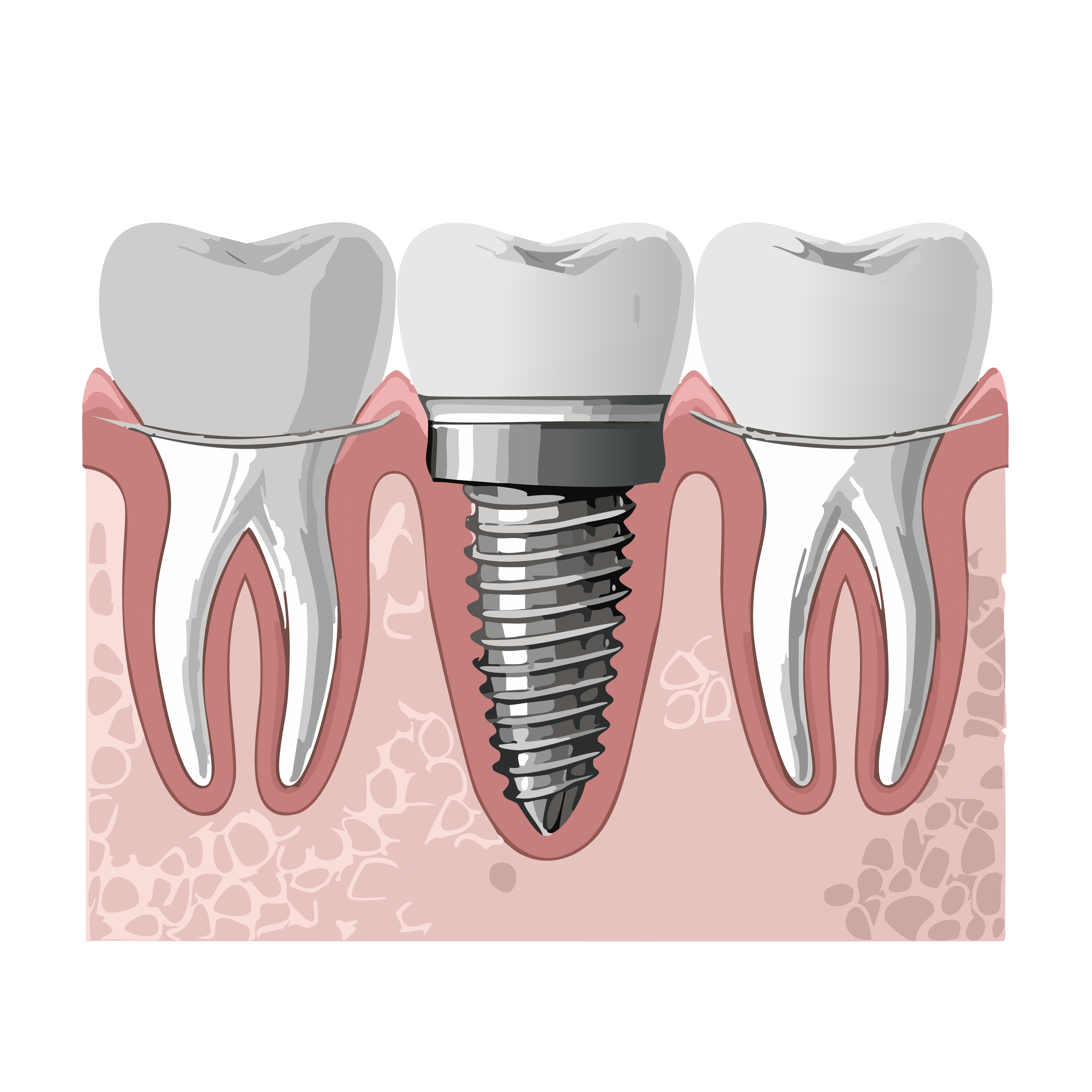 Illustration of 3 teeth. The middle one has been replaced by a dental implant 