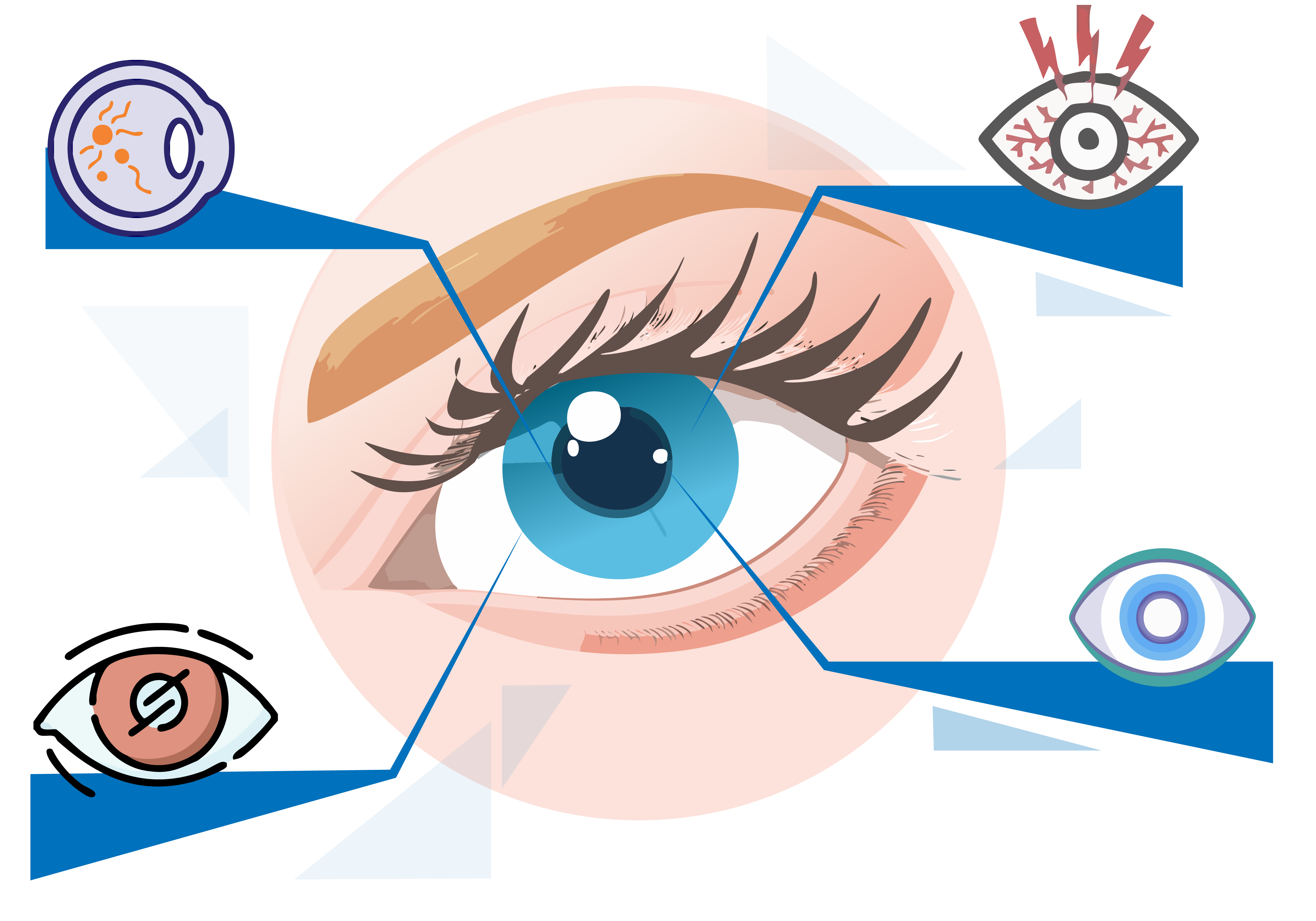 An eye with several symbols pointed out to indicate different eye issues and conditions