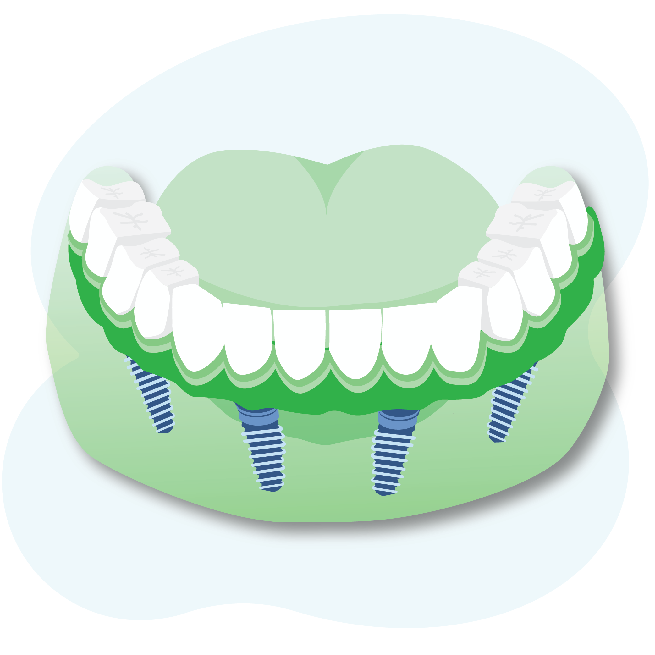 Illustration of jaw and teeth with dental implants