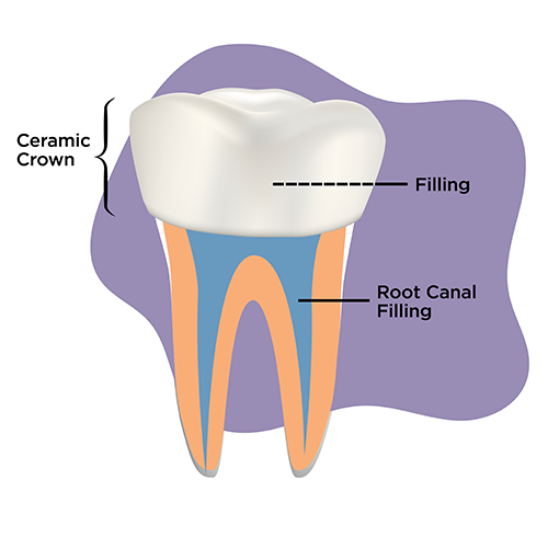 Illustration of a tooth after receiving a root canal treatment. The root canal filling is in the root of the tooth, then a filling above that and topped by a ceramic crown.