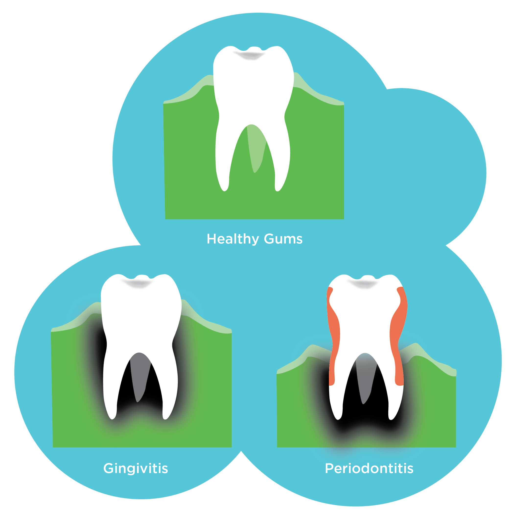 Illustrations of 3 teeth indicating healthy gums, gingivitis and periodontitis