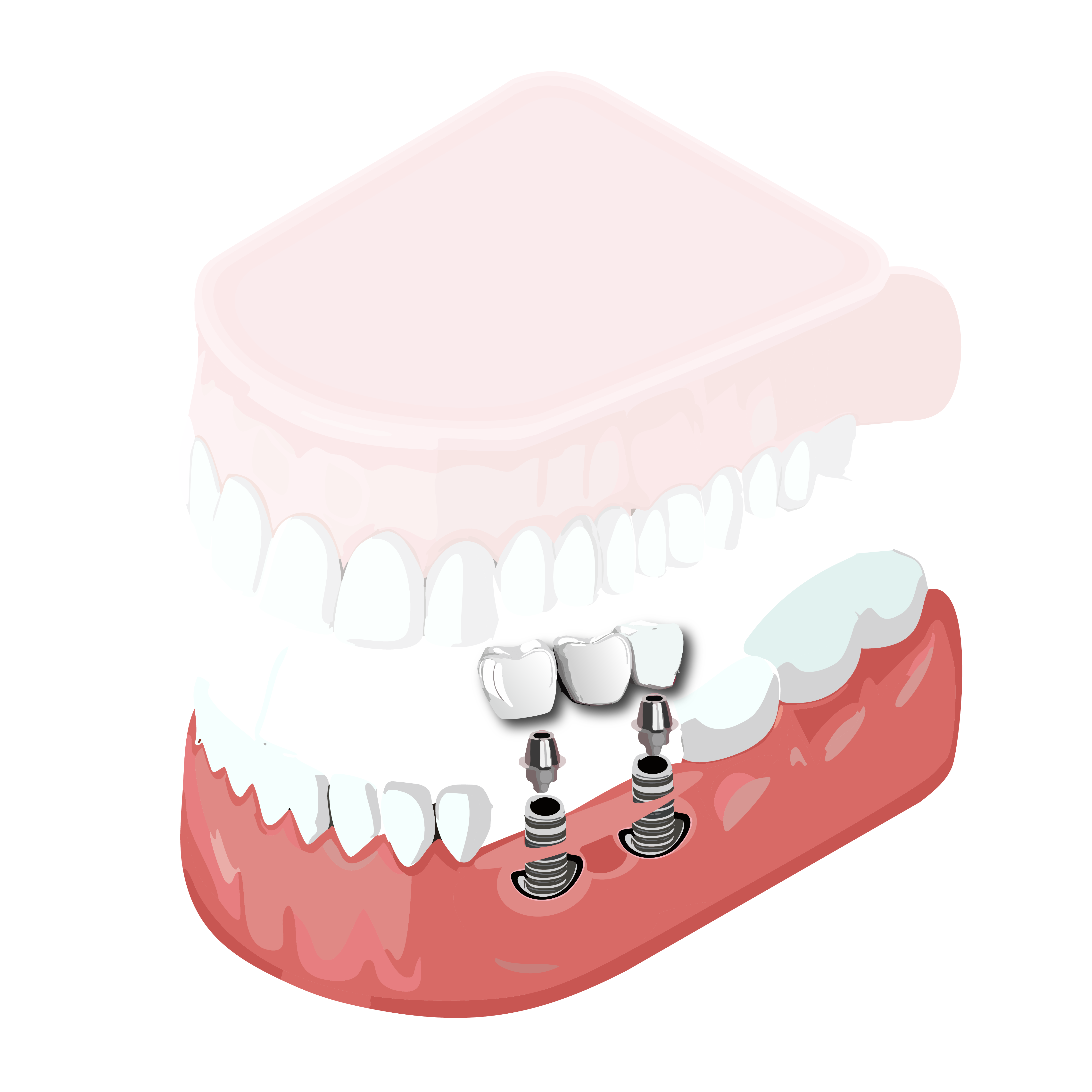 Illustration of tooth implant components being placed in the bottom jaw