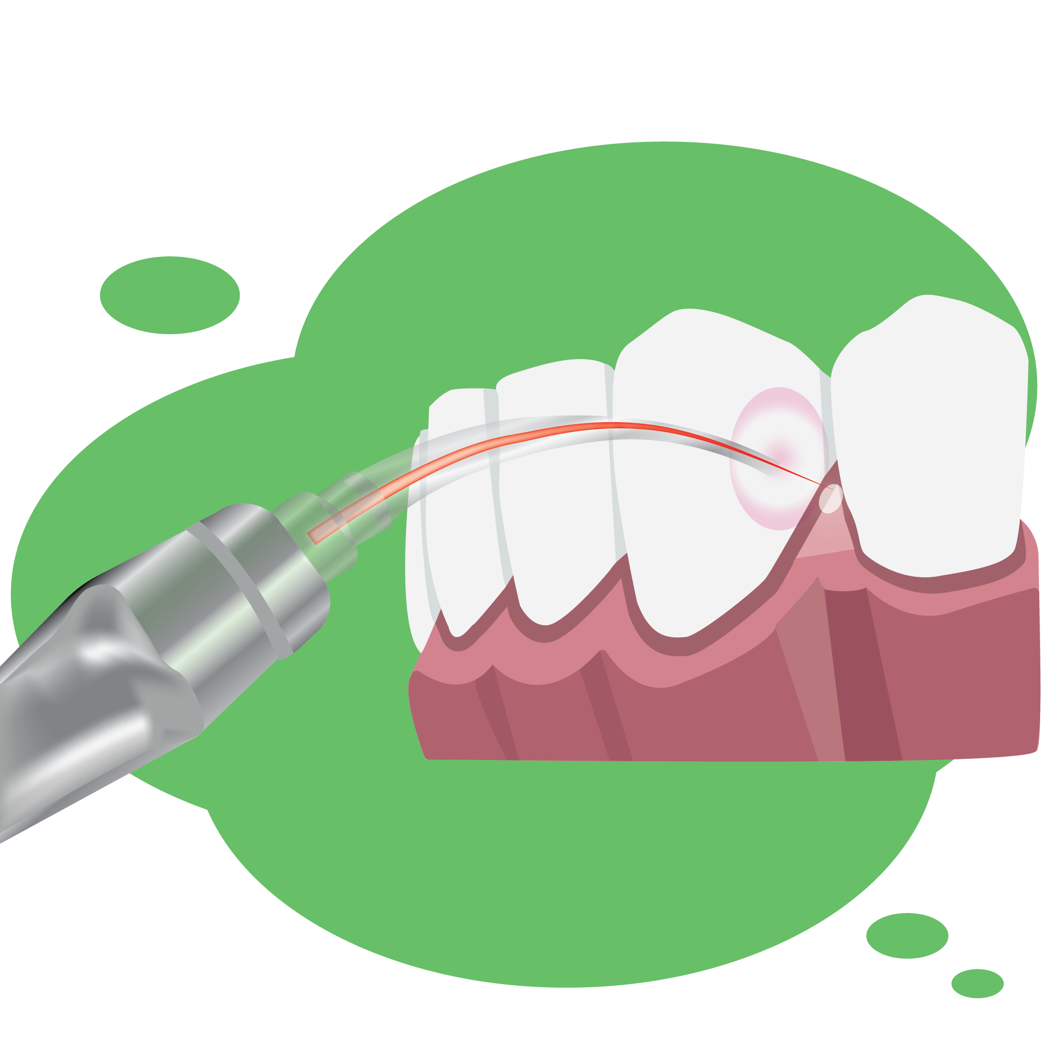 Illustration of a laser with the beam targeting the area between two teeth