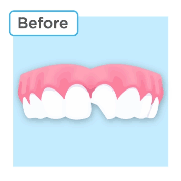 Before and afterf of a front tooth chip and repair