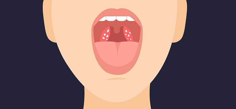 Tonsil Stones: How Can They Cause Bad Breath? - Image 1 - Listerine - en-GB