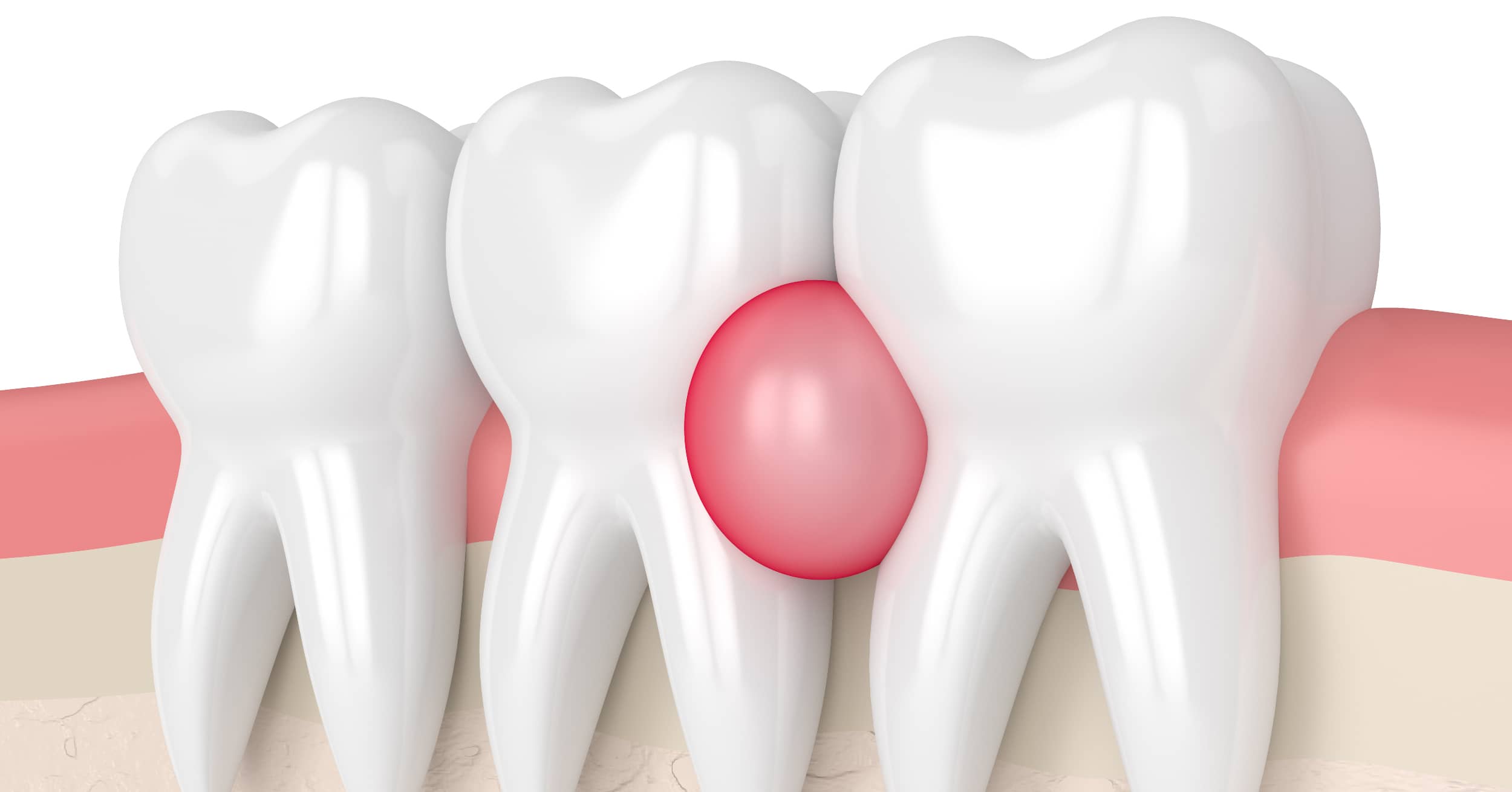 Everything You Need to Know About Gum Abscess - Image 1 - Listerine - en-GB