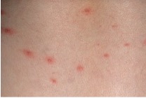 chicken Pox