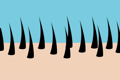 Scalp with multiple hairs, a full head of hair before hair loss occurs to display causes of hair loss.