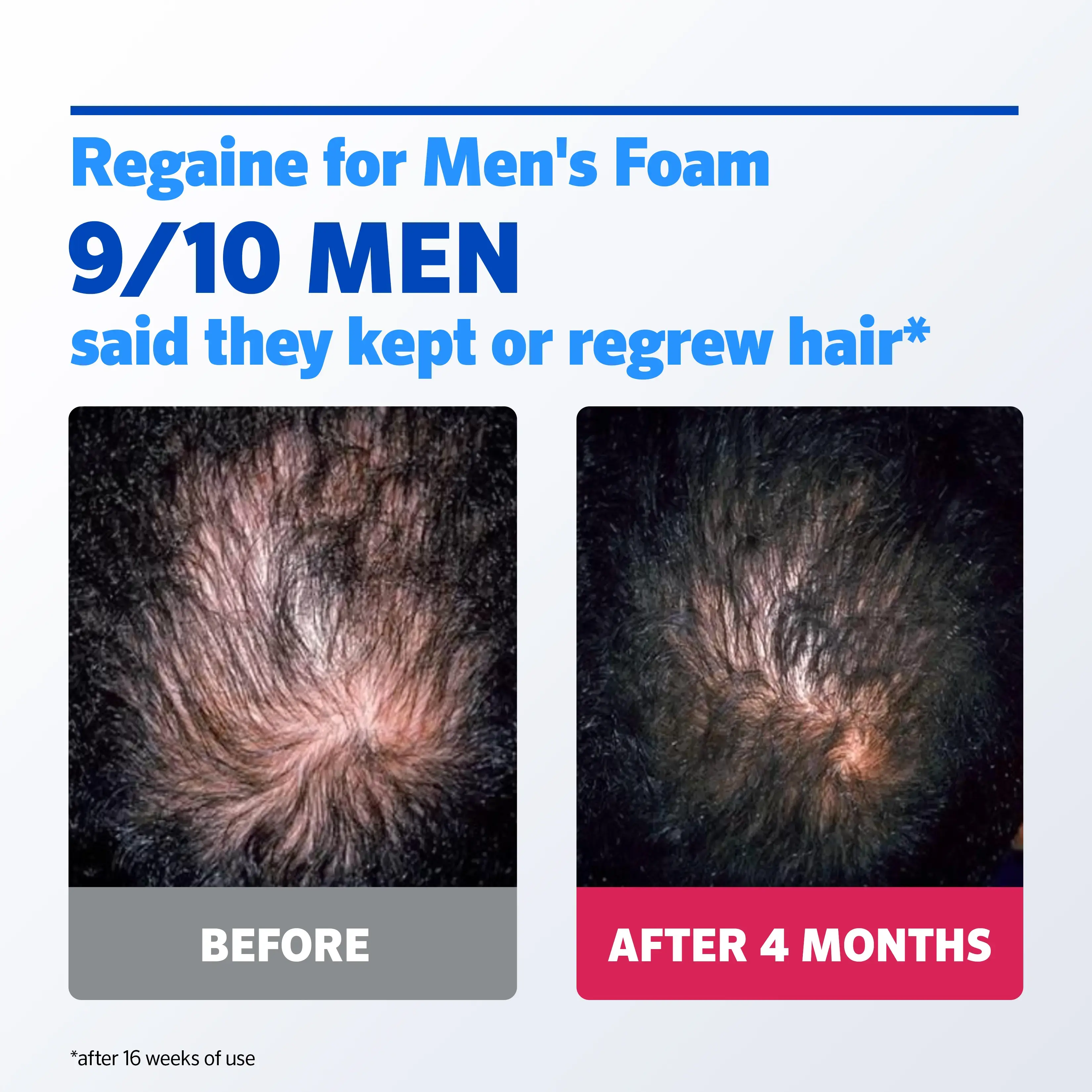 REGAINE® FOR MEN EXTRA STRENGTH SCALP FOAM FOR HAIR REGROWTH