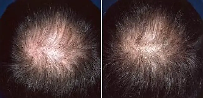 Regaine for Men clinical trial before and after