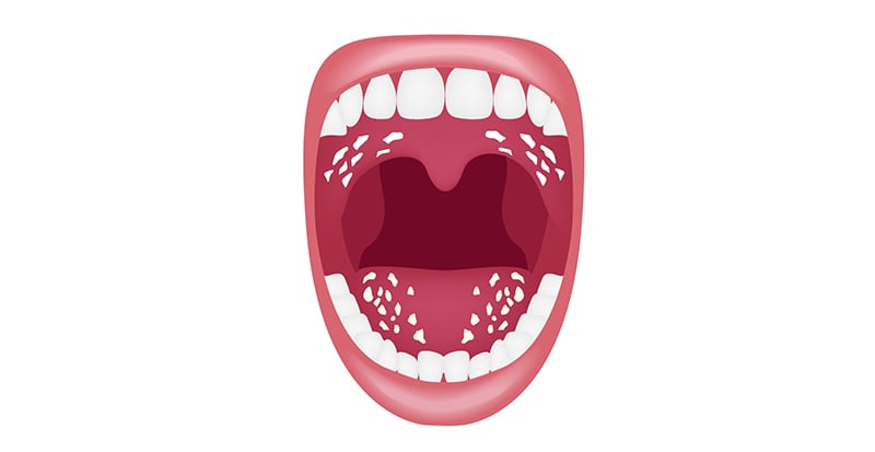 Understanding Oral Thrush (Oral Candidiasis) - Image 1 - Listerine - en-GB