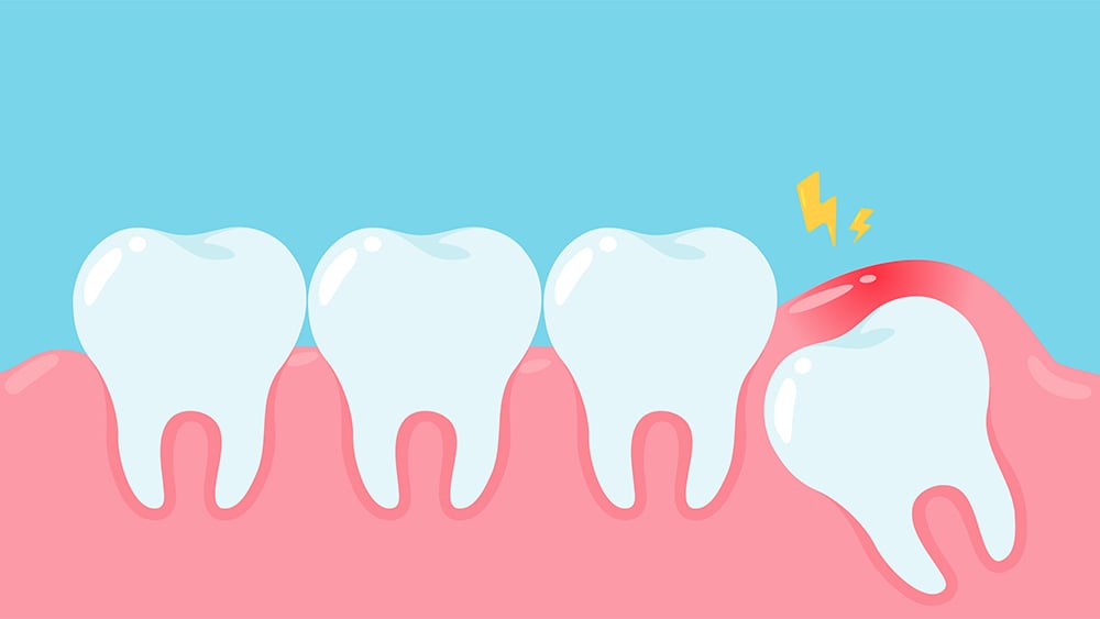 Everything You Need to Know About Wisdom Teeth - Image 1 - Listerine - en-GB