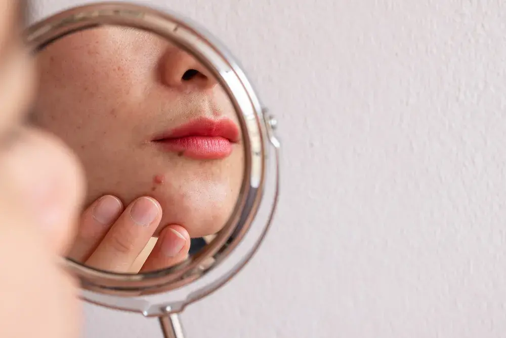A woman with acne looks into the distance. 