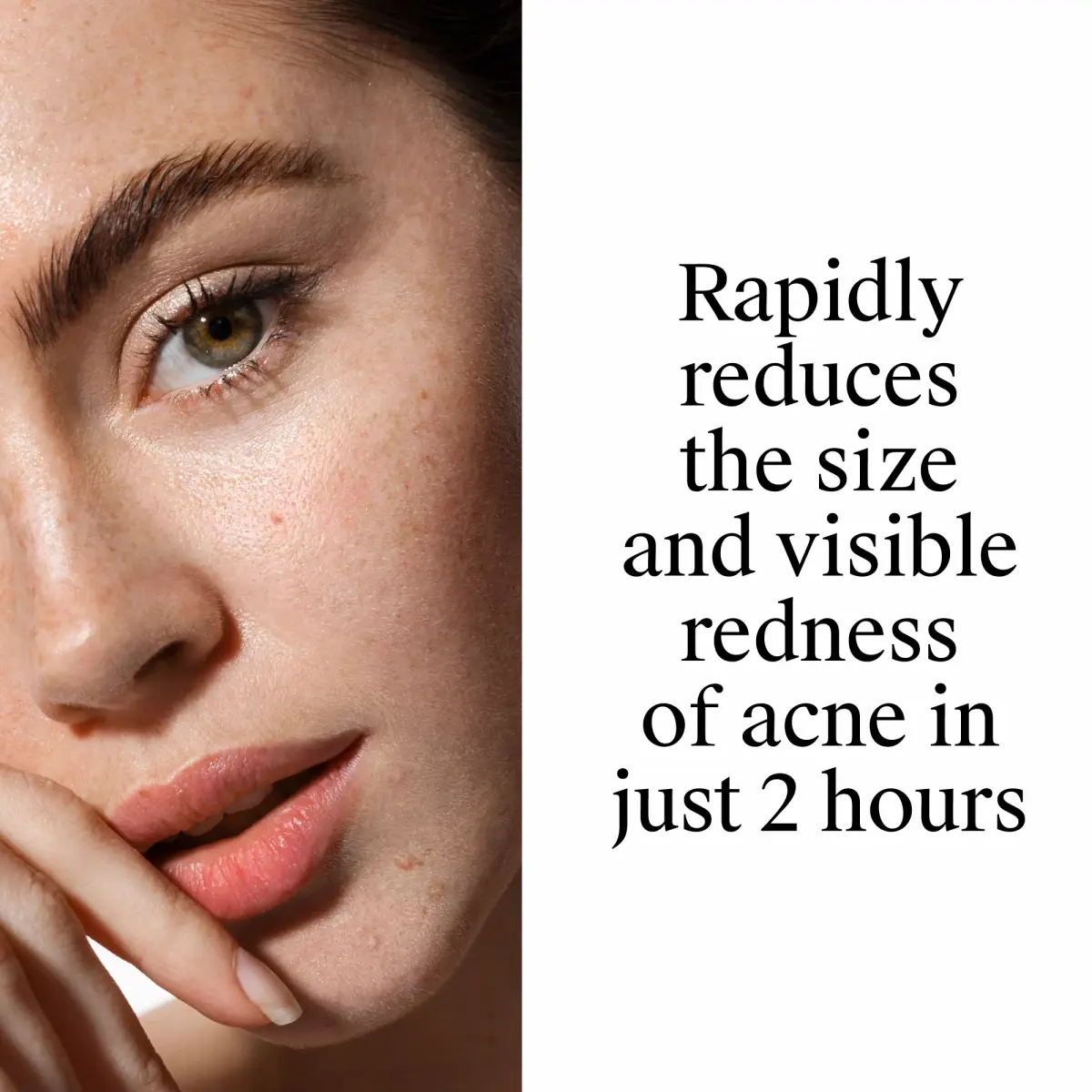 Neutrogena® Rapid Clear Stubborn Acne Spot Gel rapidly reduces the size and visible redness of acne in just 2 hours