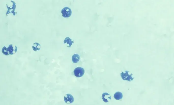 2% N-Acetyl Glucosamine exfoliates to fade the look of post-acne marks