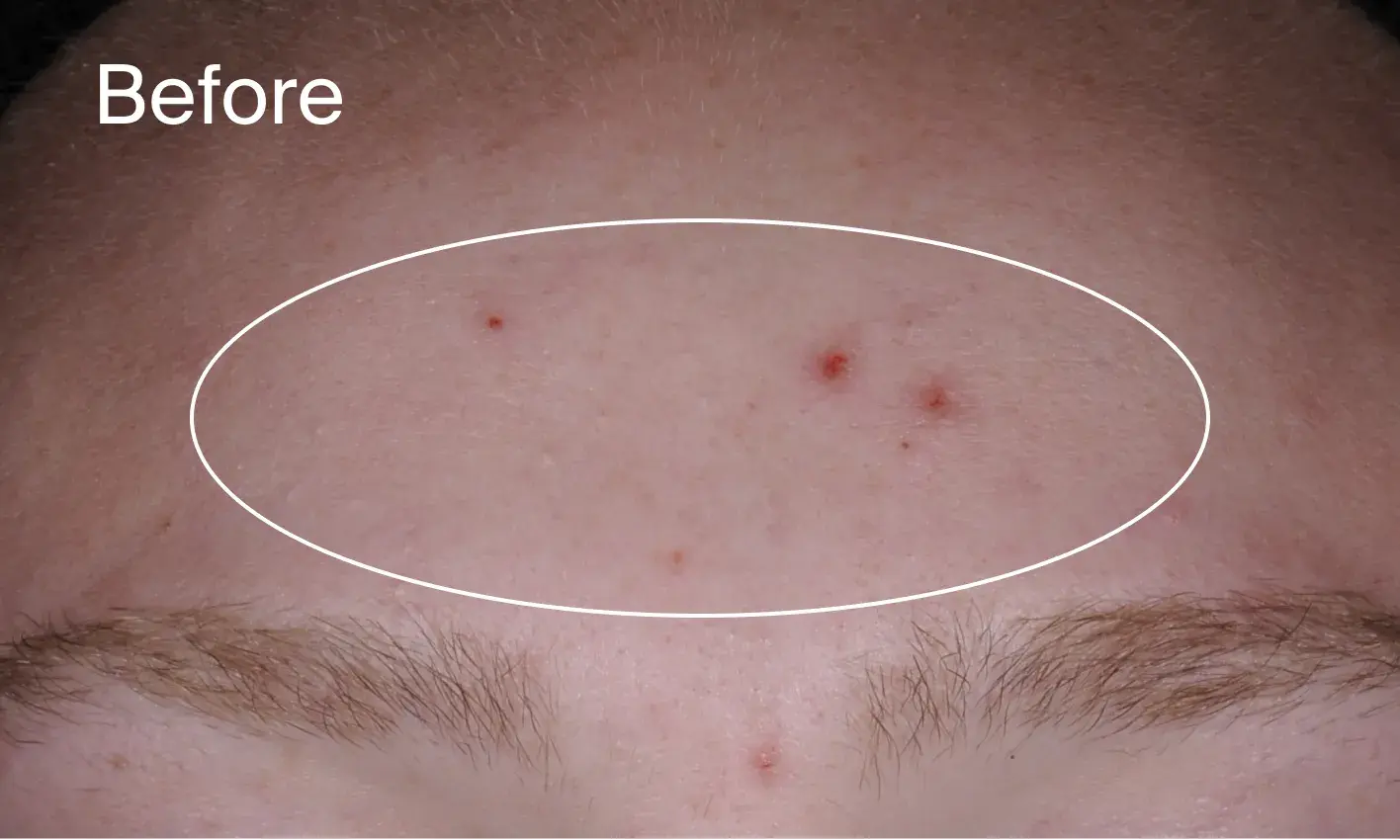 Image showing post-acne marks before applying Neutrogena® Evenly Clear™ Acne Cleanser