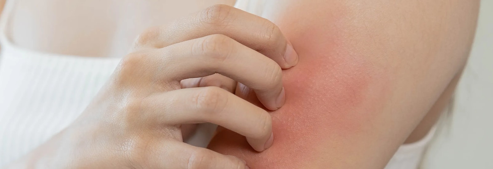 A woman scratches a red rash on her arm.