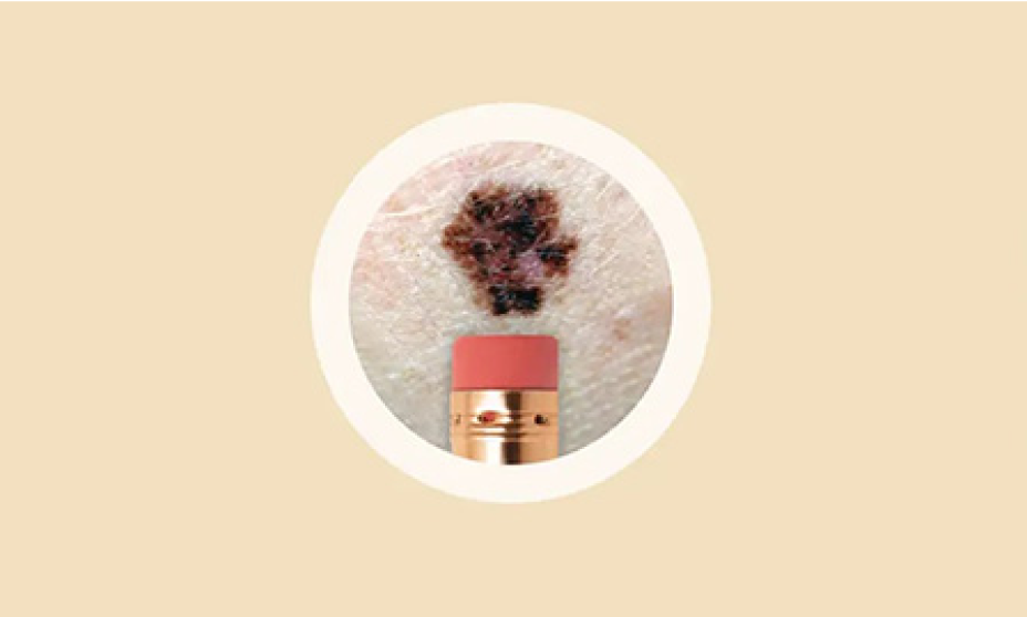 ABCDEs of melanoma. Diameter, size. Size of the mole is bigger than a pencil eraser.