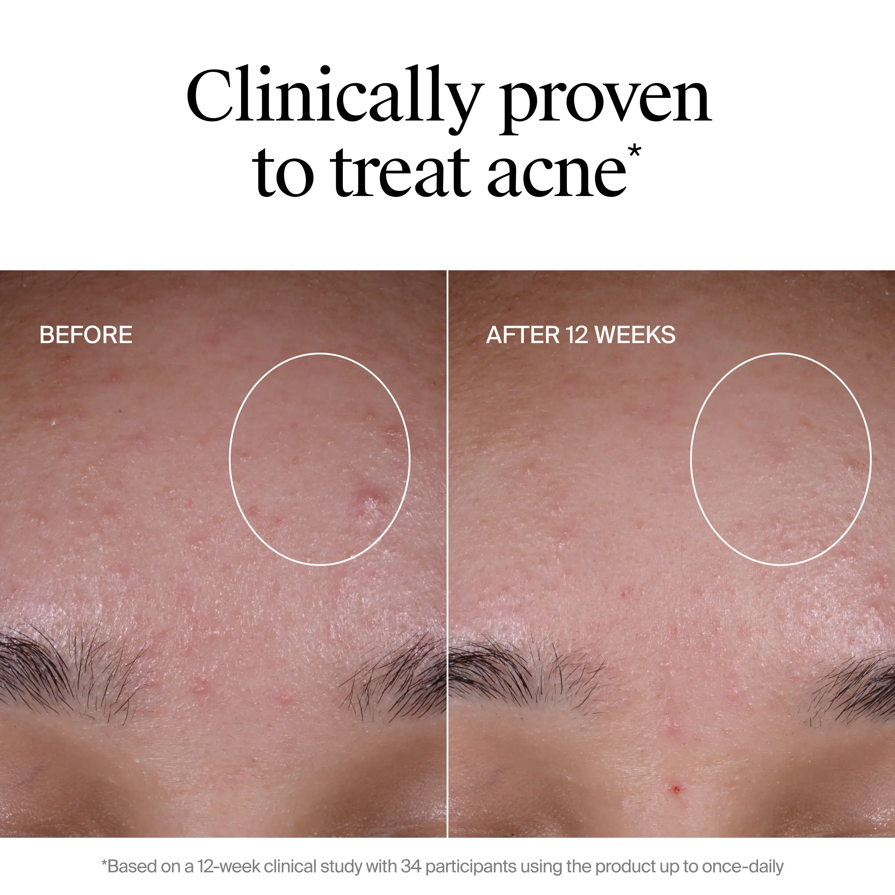 Clinically proven to treat acne. Before and After image showing less acne after 12 weeks