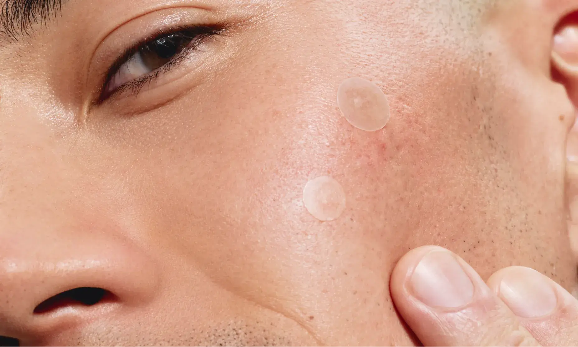 A close-up of a person's cheek with two Neutrogena® Mini Acne patches applied.