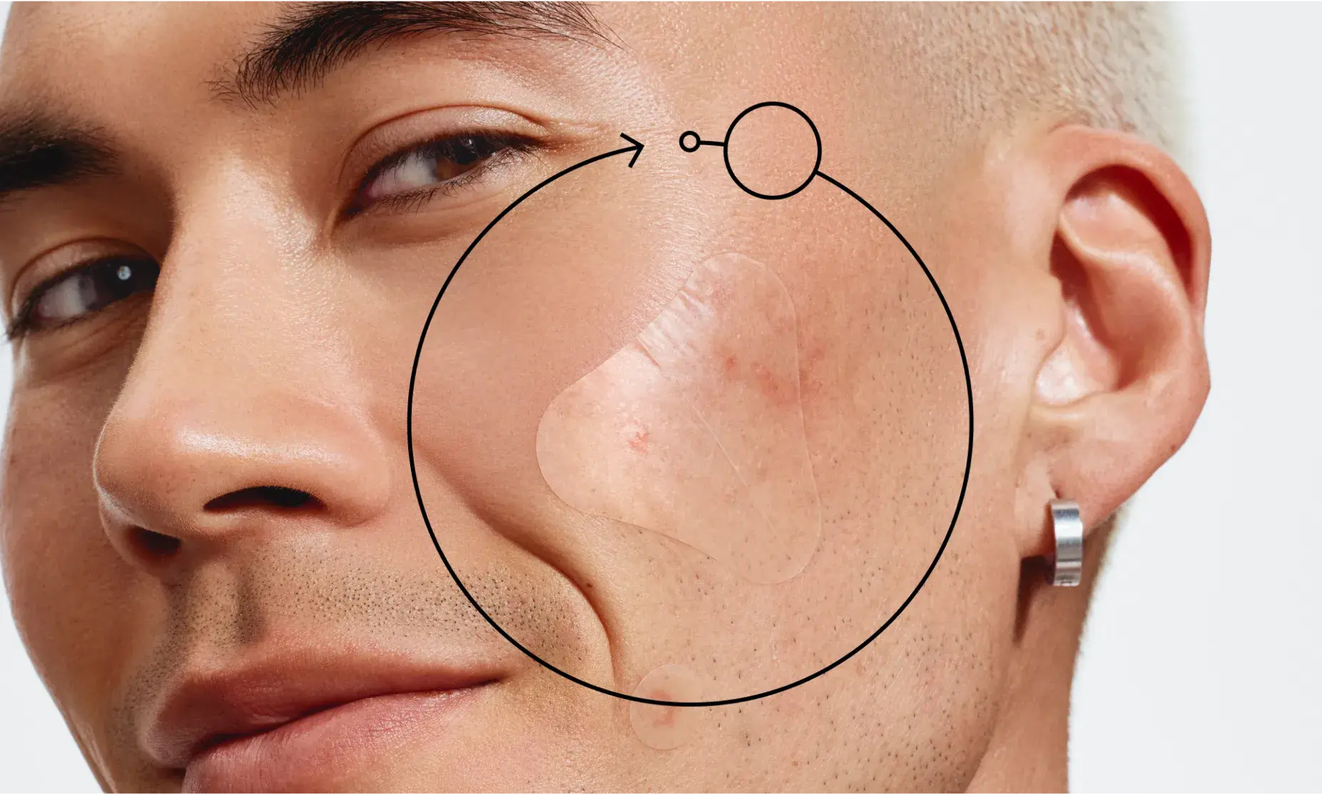 A close-up of a person's cheek with a clear Neutrogena® Sensitive Skin Triangle Acne Patch over a blemish.