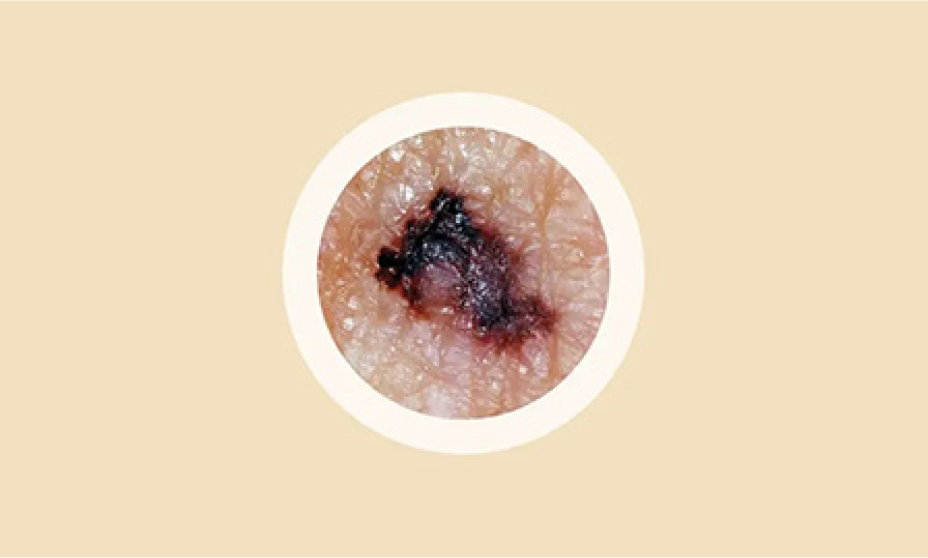ABCDEs of melanoma. Border irregularity, ragged edges. Border of the mole looks ragged or blurry.