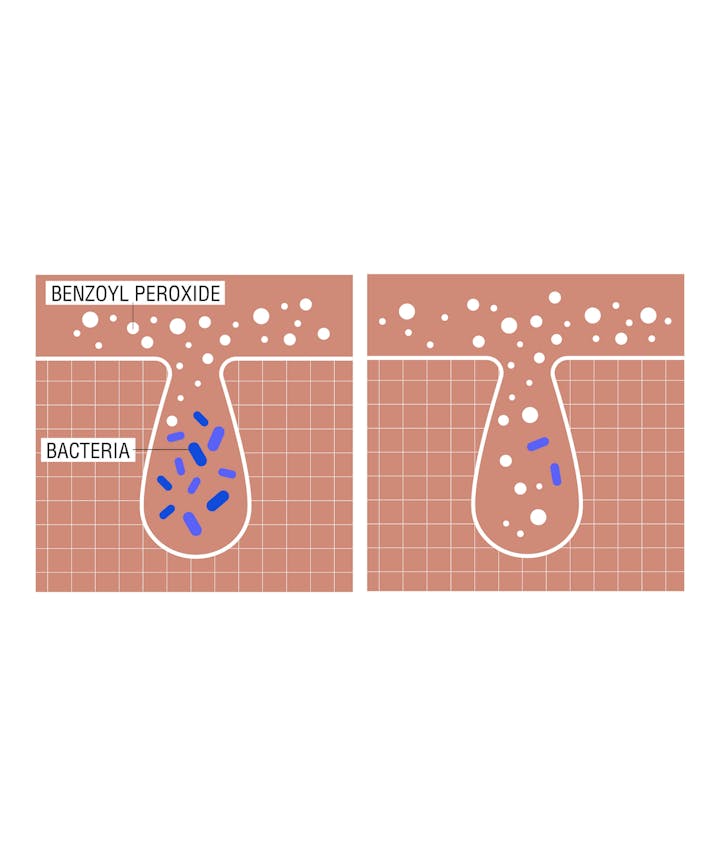 Stubborn Acne AM Treatment