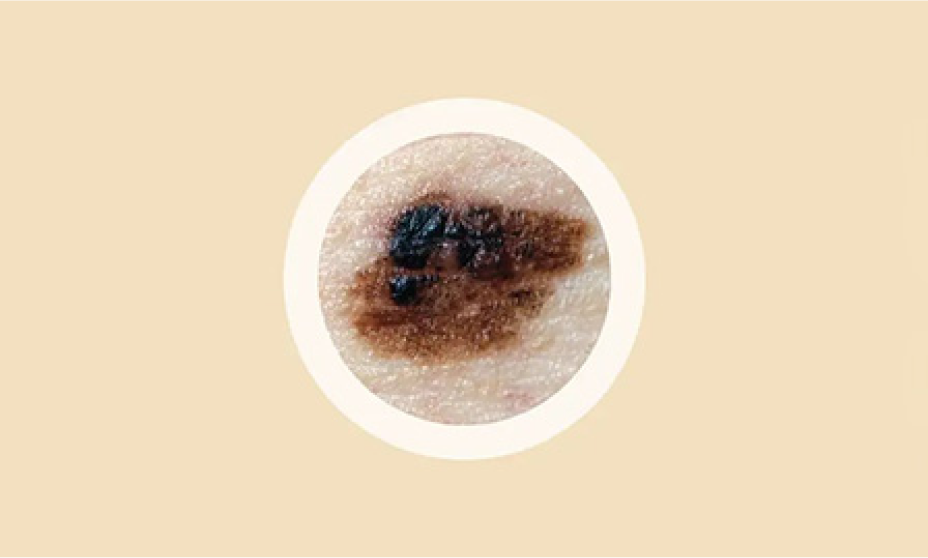 ABCDEs of melanoma. Asymmetry, uneven shape. One half of a mole looks different from the other.