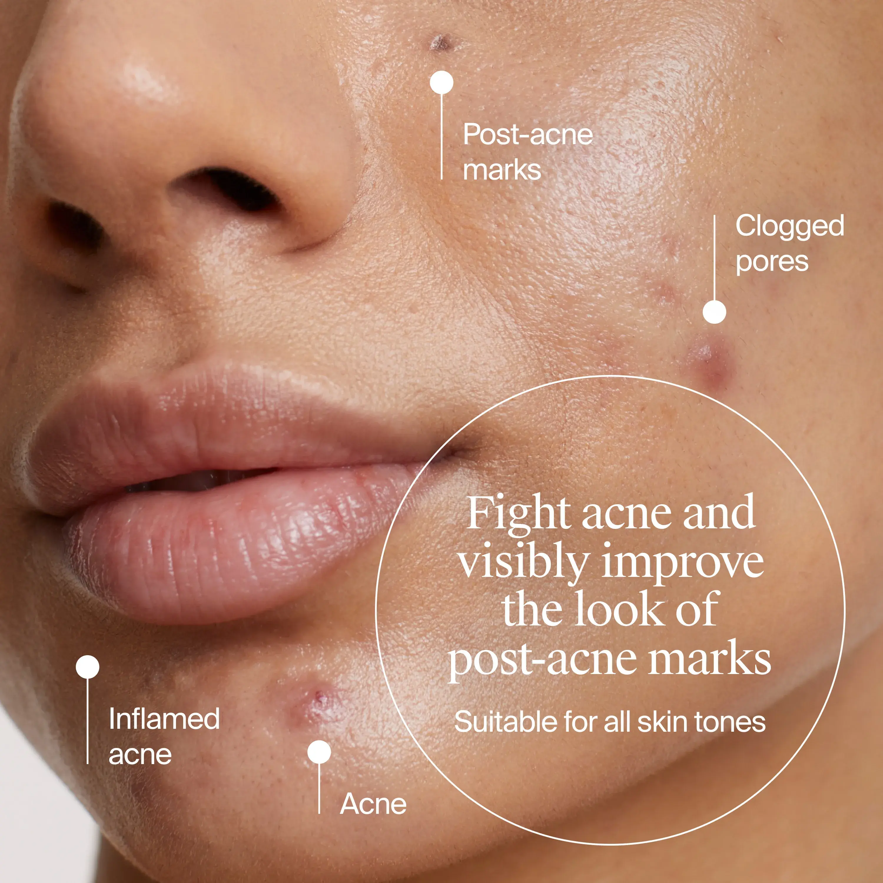 Image of woman with acne marks. Fight acne and visibly fade the look of post-acne marks suitable for all skin tones