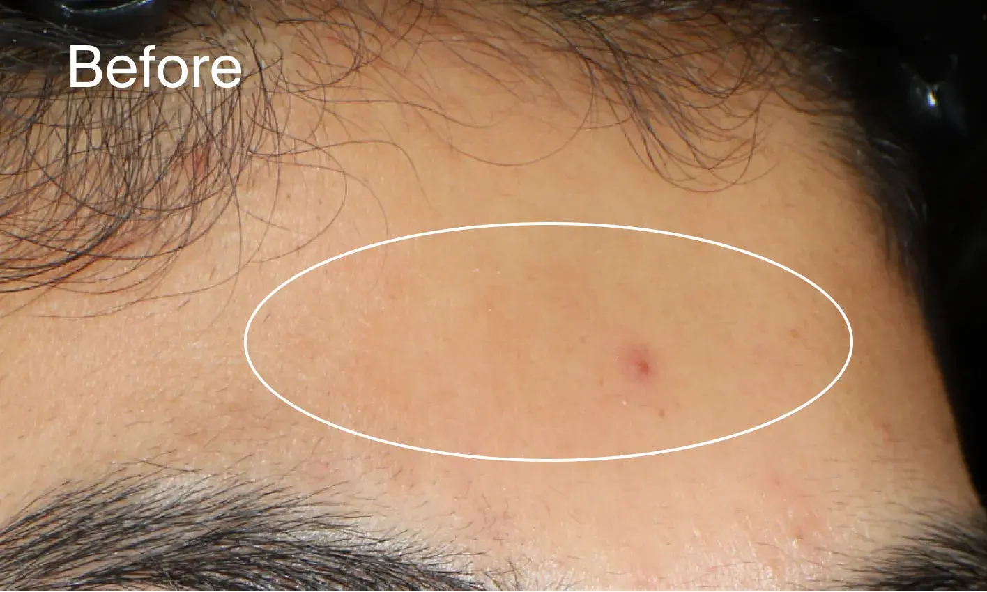Image showing acne marks before applying Neutrogena® Evenly Clear™ Acne Gel Moisturizer