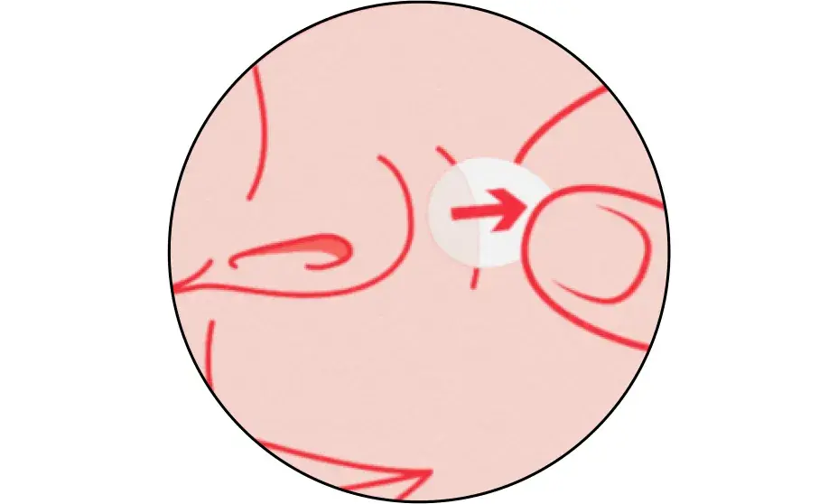 Remove patch. Peel off when patch turns with or 6-8 hours after application.