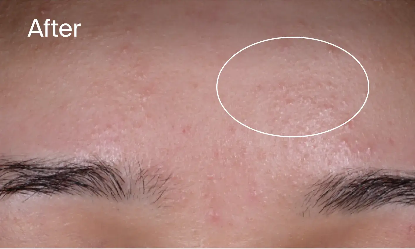 After Image Forehead clear of acne marks after applying Neutrogena® Evenly Clear™ Acne Exfoliant