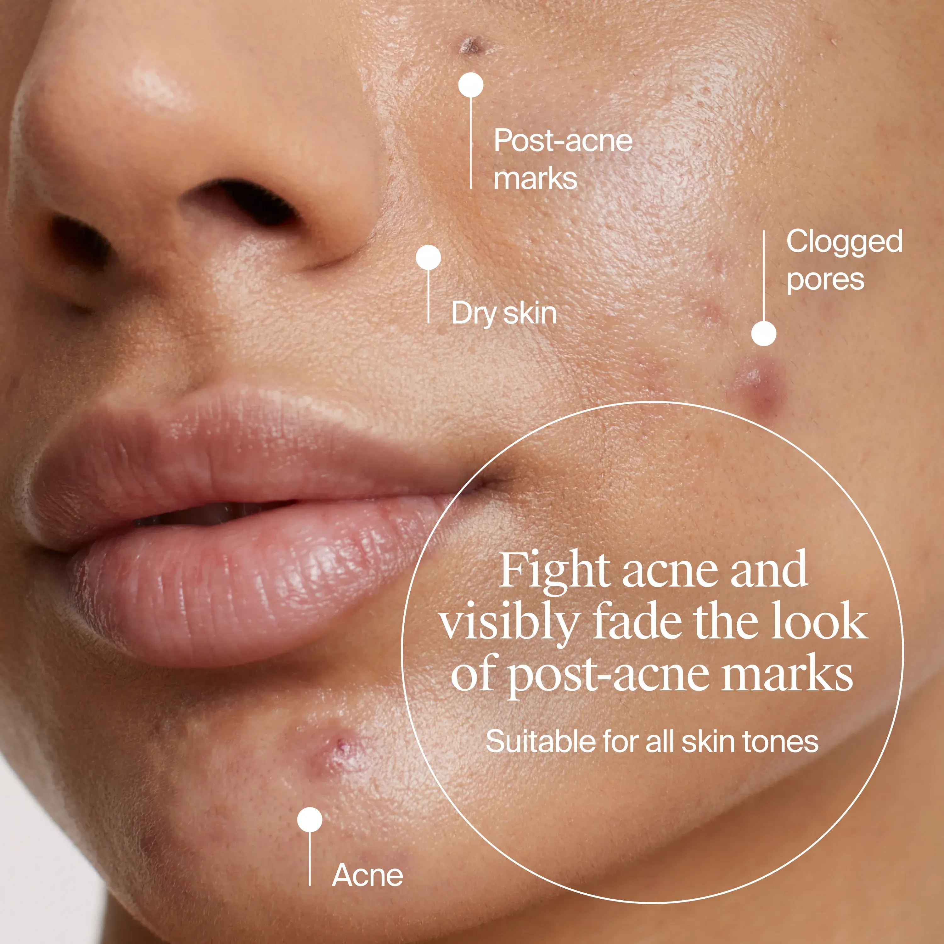 Image of woman with acne marks. Fight acne and visibly fade the look of post-acne marks suitable for all skin tones