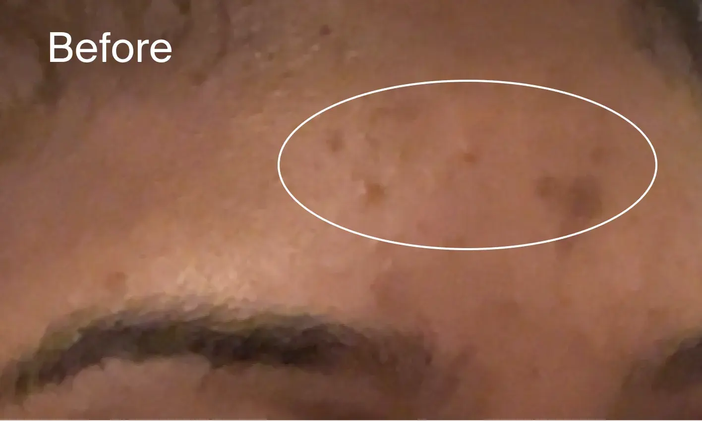 Before Image: Forehead with acne marks before applying Neutrogena® Evenly Clear™ Facial Retinoid