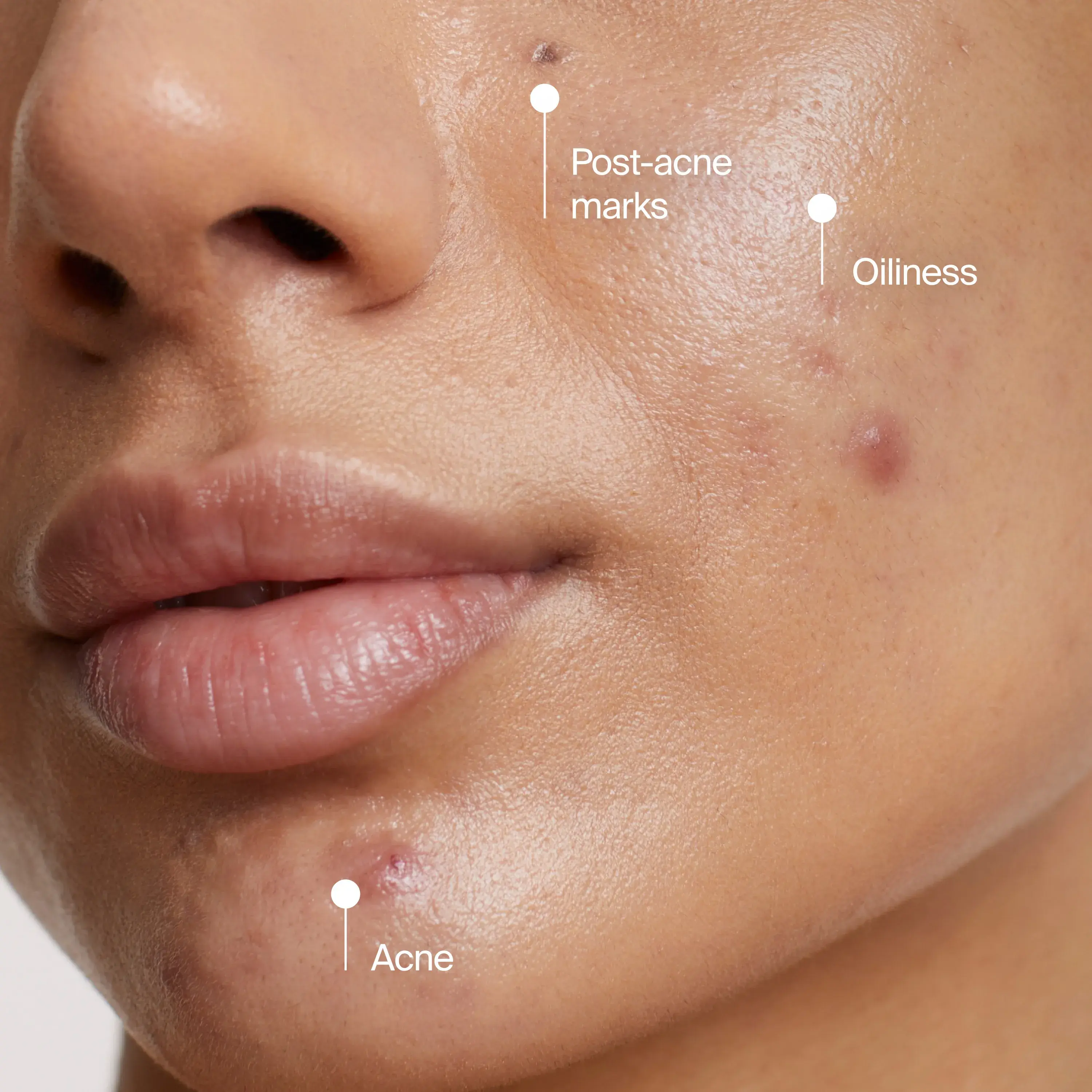 Woman with post-acne marks, oilness, acne