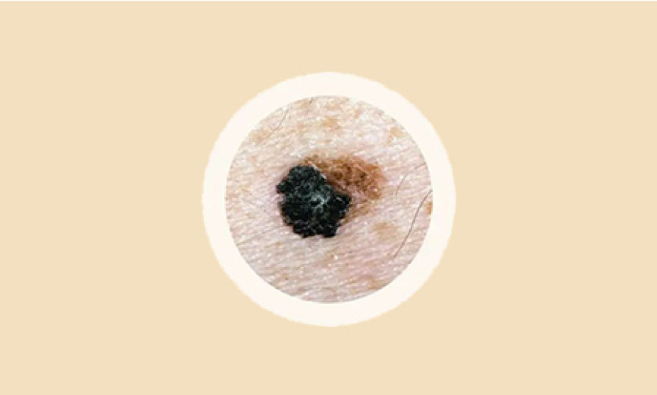 ABCDEs of melanoma.: Evolving. Mole changing size, shape, color or height. Or any new symptoms in like bleeding, itching or crusting.