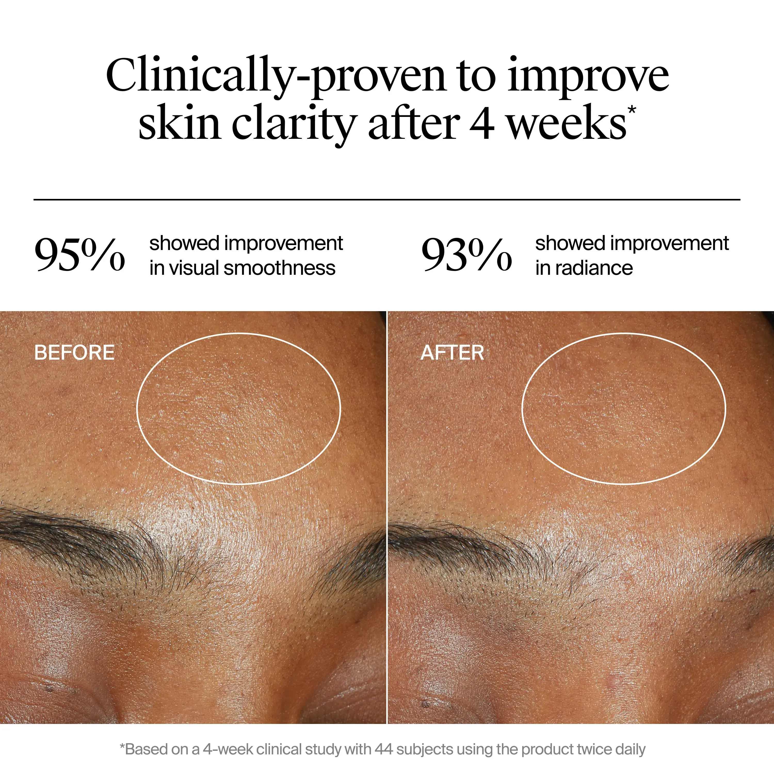 Clinically-proven to improve skin clarity after 4 weeks. Image showing Before and After. 95% showed improvement in visual smoothness, 93% showed improvement in radiance