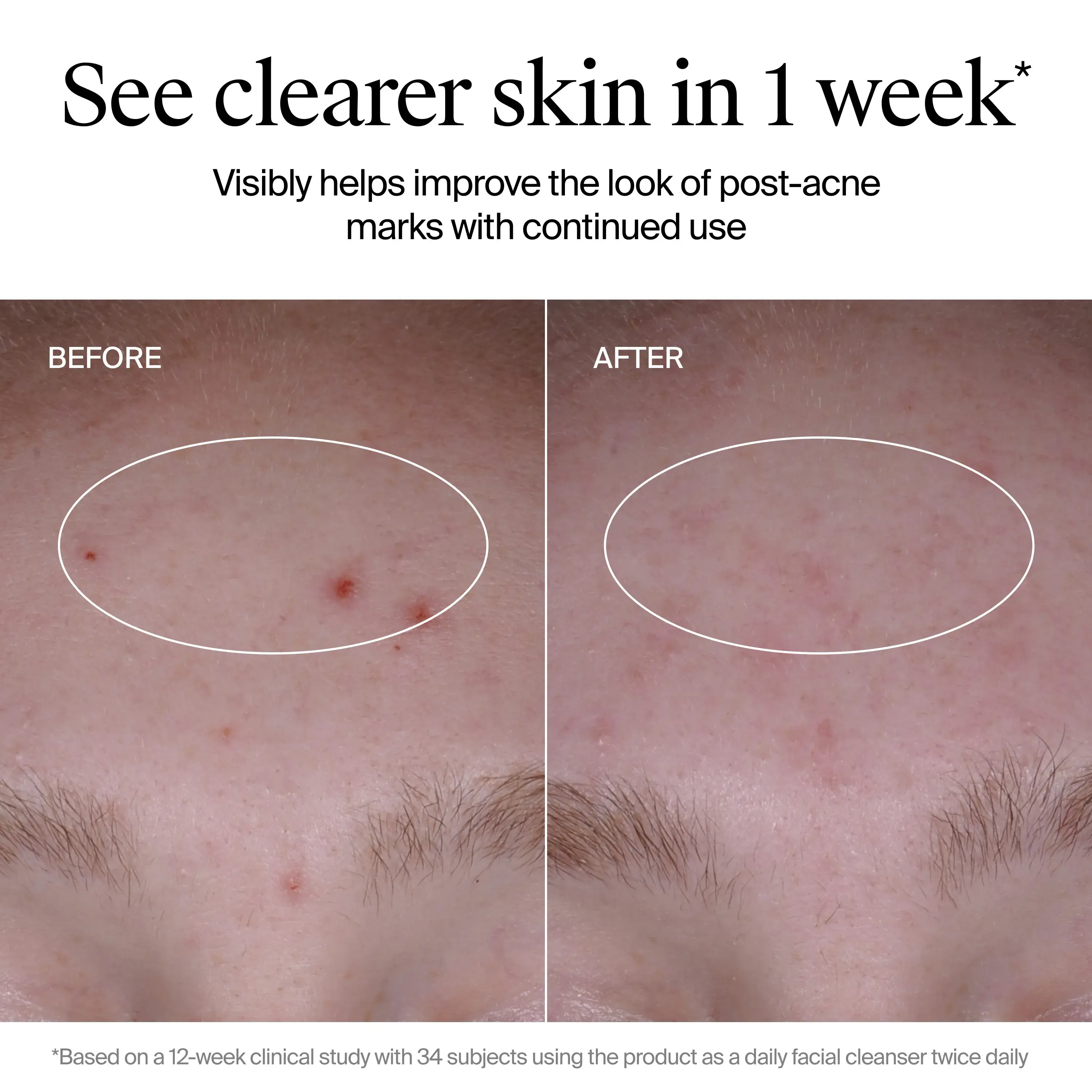 See clearer skin in 1 week. Visibly helps improve the look of post-acne marks with continued use. Before and After image showing results