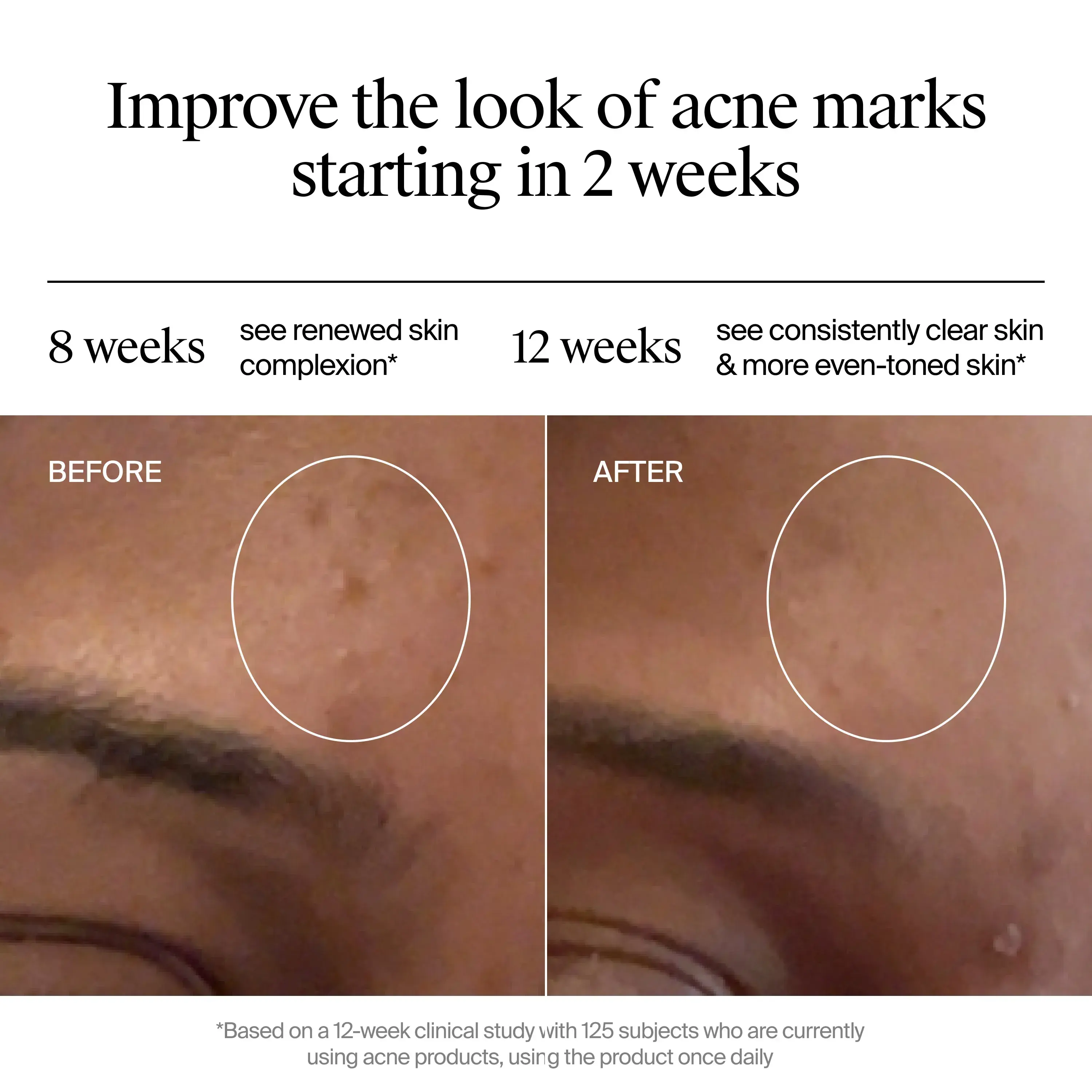  Improve the look of acne marks starting in 2 weeks. Before and After image showing less acne after 12 weeks
