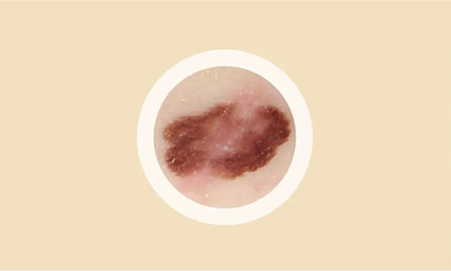 ABCDEs of melanoma. Color - Different colors in the same mole.