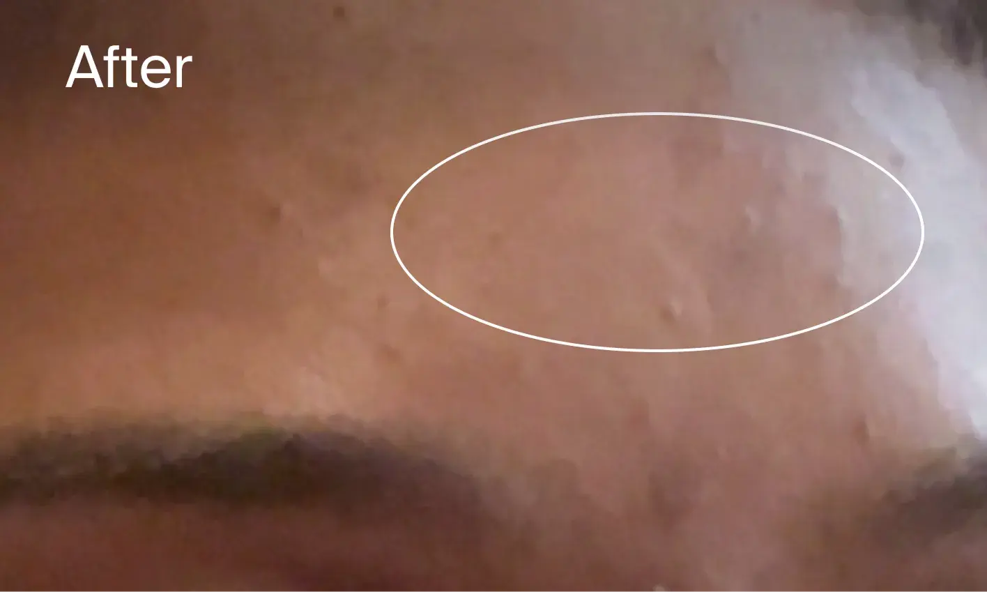 After Image Forehead clear of acne marks after applying Neutrogena® Evenly Clear™ Facial Retinoid for 2 weeks