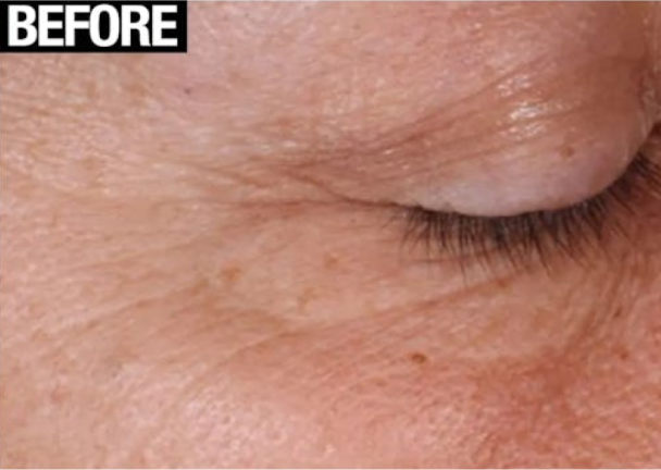 Neutrogena Rapid Wrinkle Repair Reduces Fine Lines and Wrinkles In Just 12 Weeks