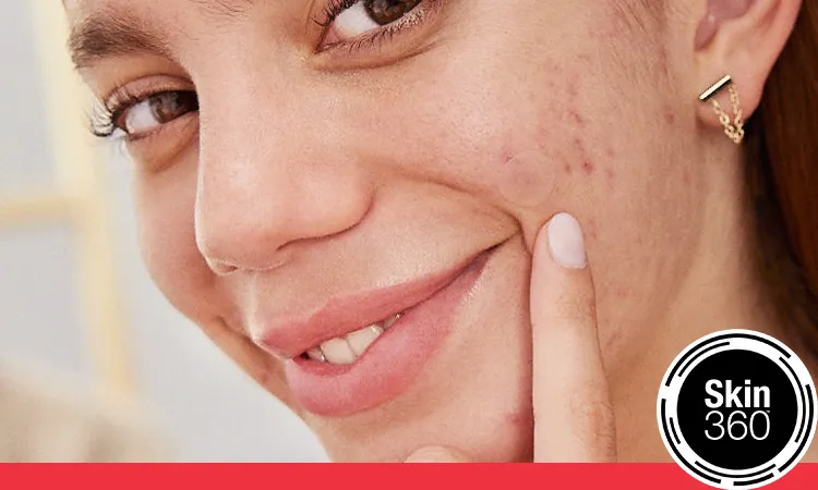 Rapid Clear® Acne Treatment With Benzoyl Peroxide