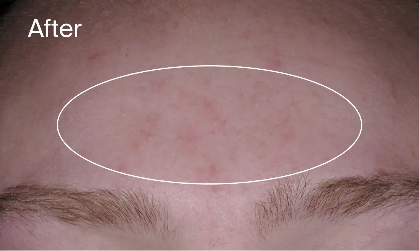 results of using Neutrogena® Evenly Clear™ Acne Cleanser for 1 week on post-acne marks