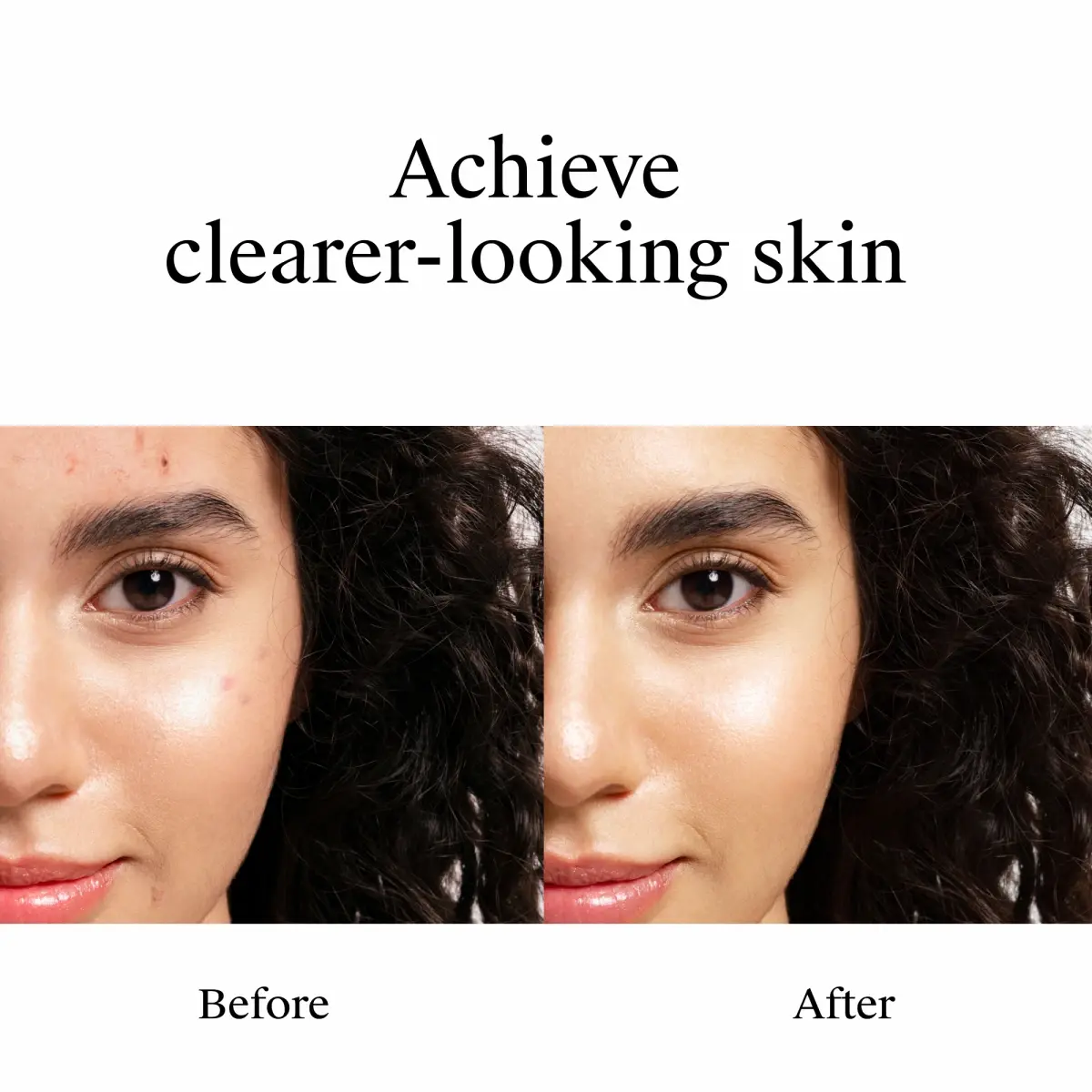Achieve clearer-looking skin. Image displays woman clear of acne before and after using Neutrogena® Rapid Clear Stubborn Acne Spot Gel
