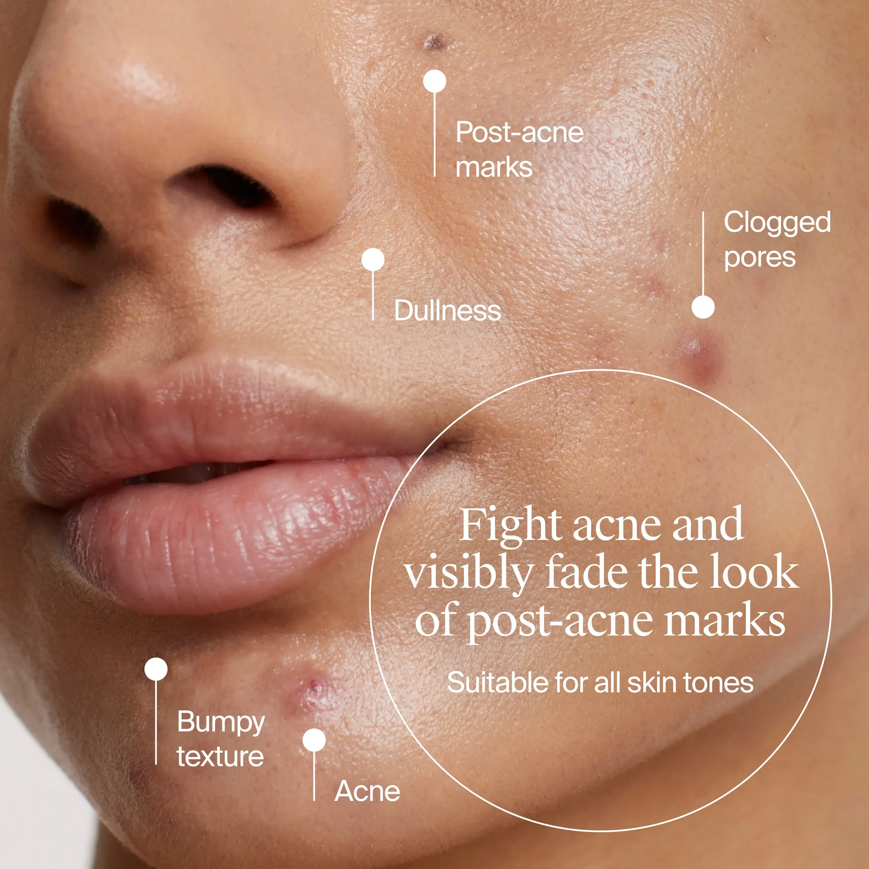 Image of woman with acne marks. Fight acne and visibly fade the look of post-acne marks suitable for all skin tones